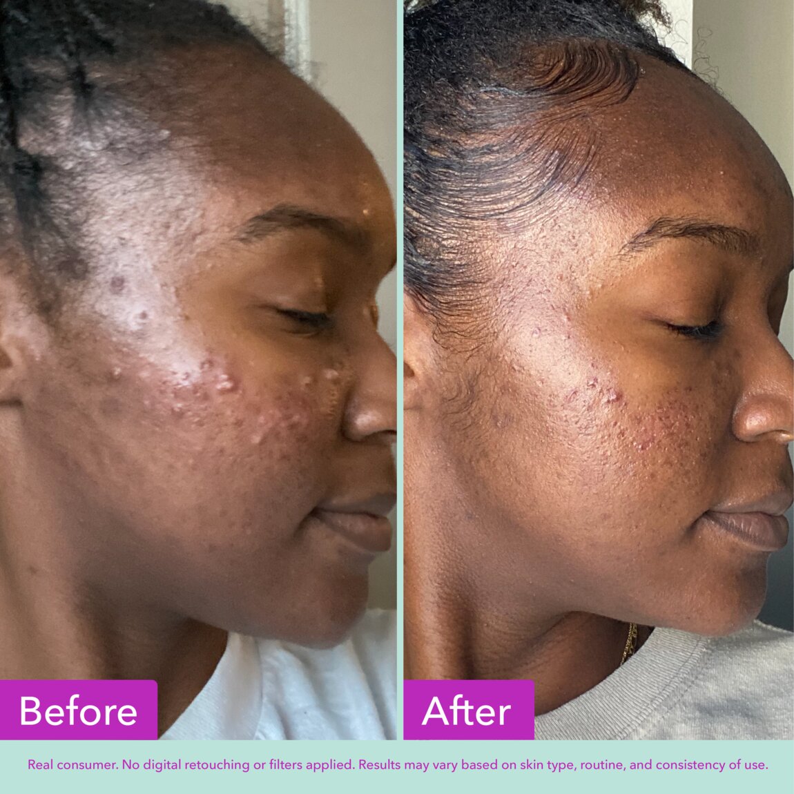 acne-foaming-cleanser-j9 zb_p.jpg